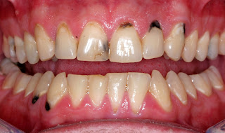 Trám răng sâu hàm trên có bền vĩnh viễn hay không?