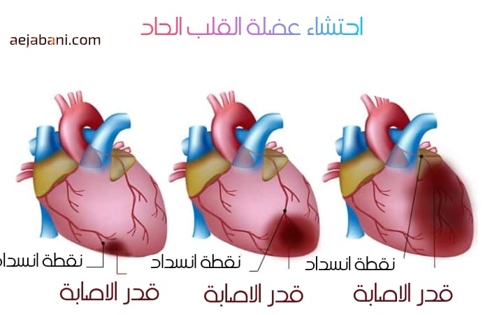 الأحتشاء الحاد هو سبب رئيسي للموت المفاجئ