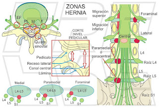 Zonas de localización de las hernias de disco.