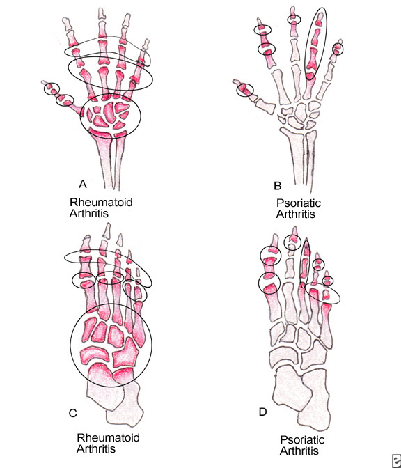 Radiology Pearls Comparison between psoriatic arthritis and rheumatoid