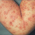 Ciri-ciri Penyakit Herpes