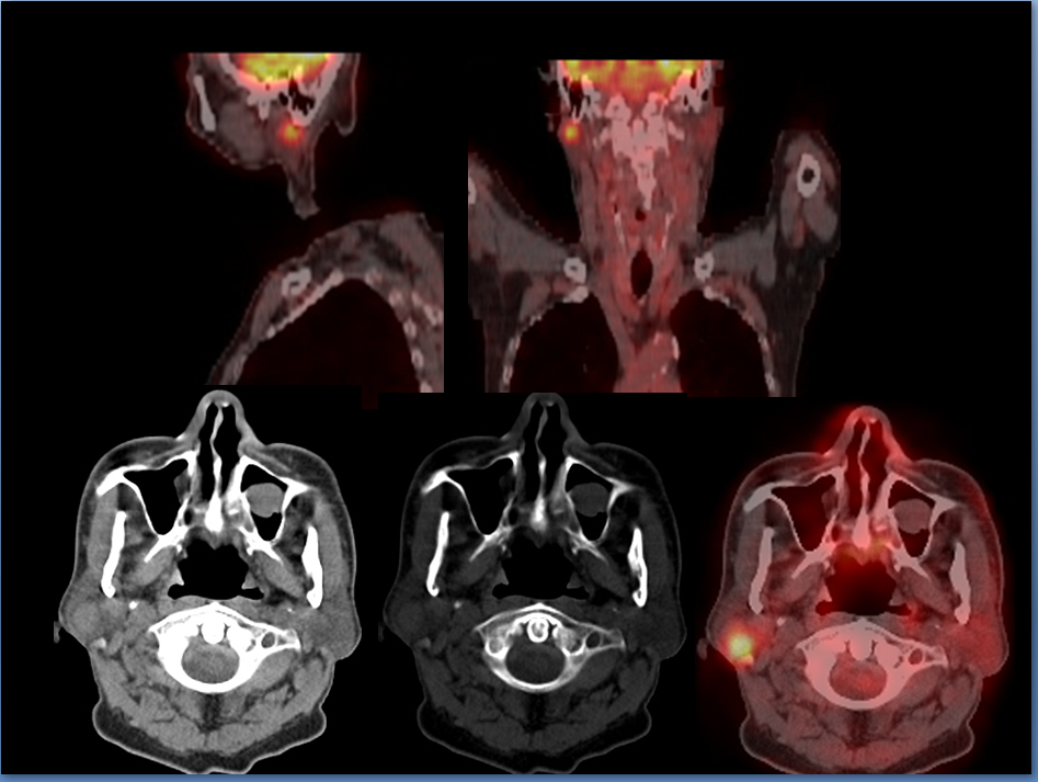 pleomorphic adenoma pet ct)