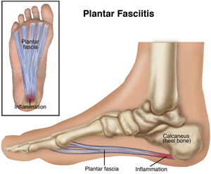 Exercises to Prevent and Manage Plantar Fasciitis - Jockvale Massage &  Physio