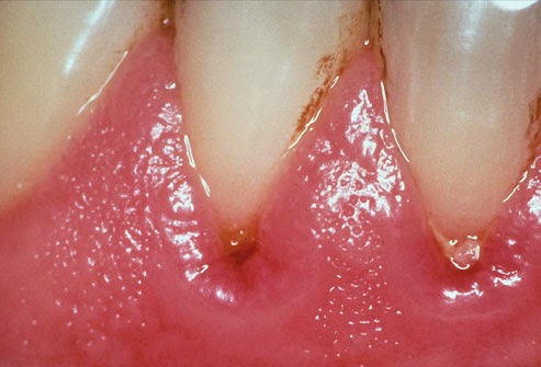 symptomes d'un abcès dentaire