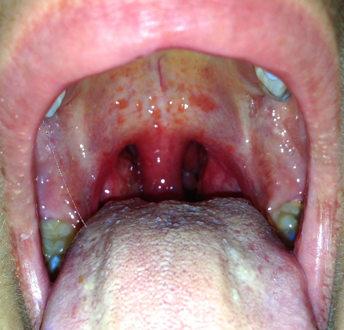 Strep Throat Pictures Without Tonsils 96