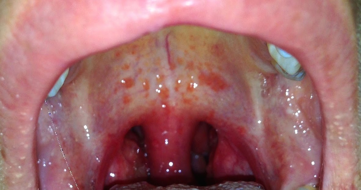 Strep Throat Tonsils 25