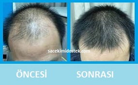 saç mezoterapisi öncesi ve sonrası 2