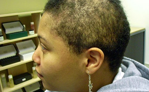 Balding Black Woman