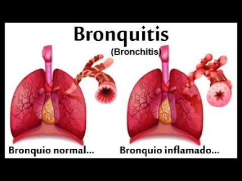 bronqitis
