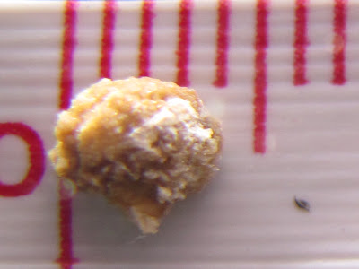 The Haddock's: Kidney Stones