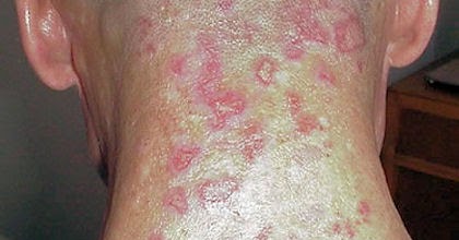 medica world: Morgellons causes treatment symptoms and signs