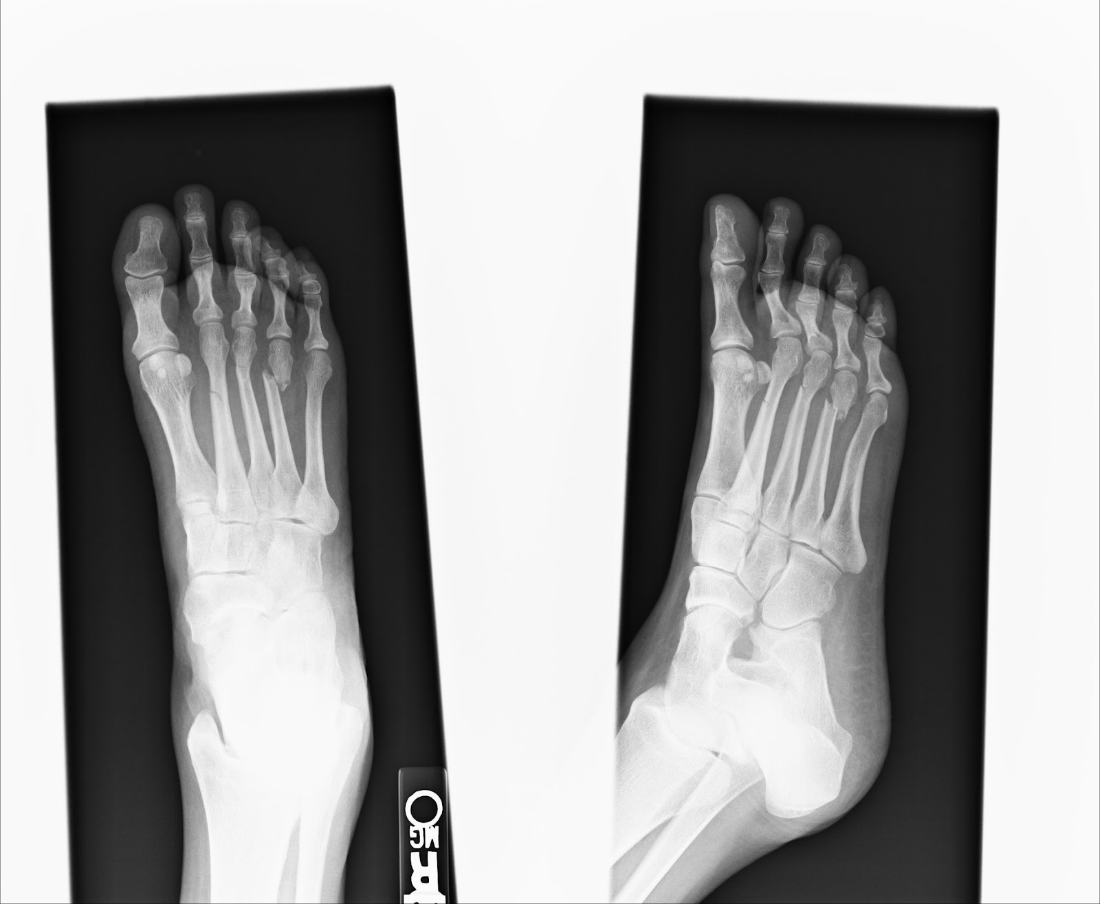 how long do fractures take to heal how long do fractures take to heal