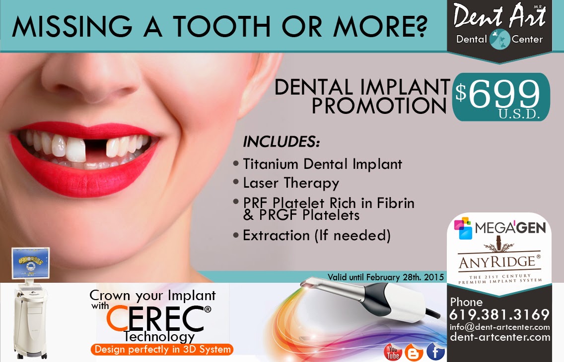 Dental Implants Dent Art Center