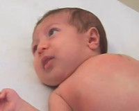 Yeni Doğan Bebeklerin Göğsünde Süt Birikmesi