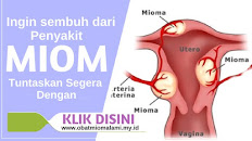 OBAT MIOM ALAMI TANPA OPERASI