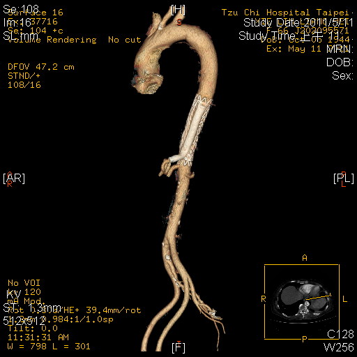 淨元法師之大醫院小醫師 That's why it's so called snorkel procedure