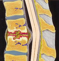 Discitis.blogspot.com: How is osteomyelitis diagnosed