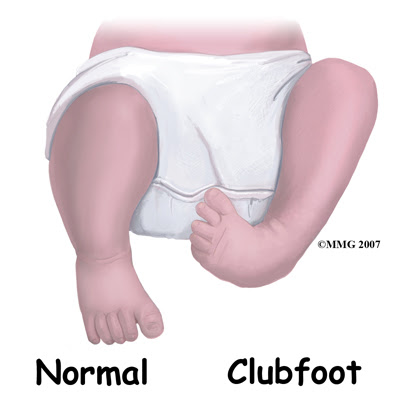 Global Clubfoot Conference Held in New Delhi