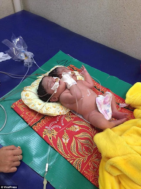 Lahir Bayi Kembali Dengan 2 Kepala Kondisinya Normal, Namun Kasihan Orang Tuanya Lahir Bayi Kembali Dengan 2 Kepala Kondisinya Normal, Namun Kasihan Orang Tuanya