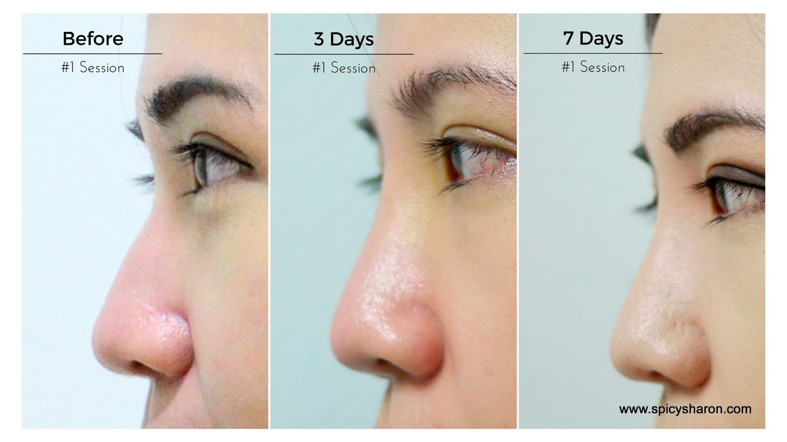 HIKO Nose Lift ME Aesthetic Clinic, Time Square KL Review