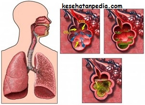Pengobatan penyakit paru-paru basah