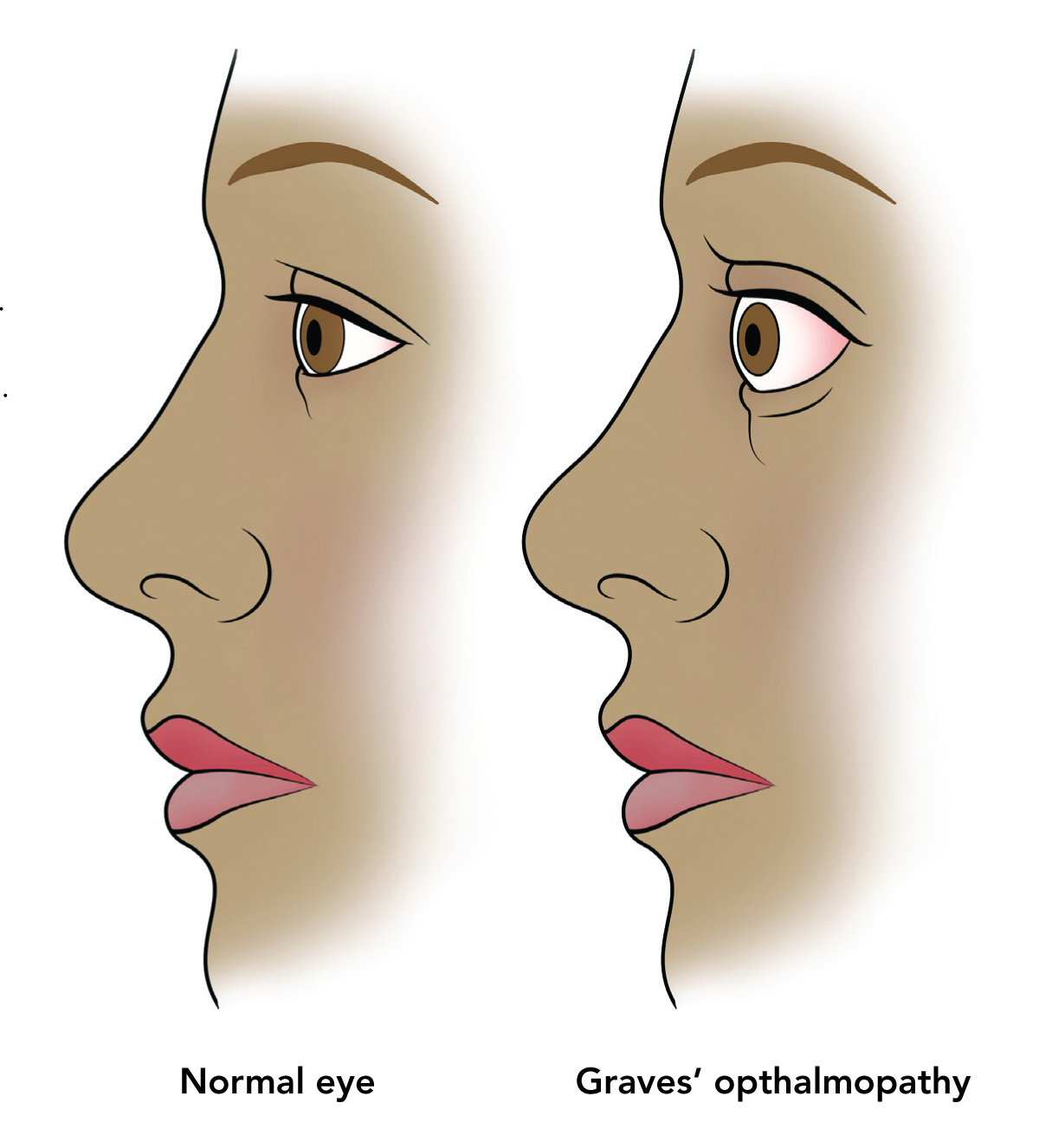 Medical info مرض جراف "Graves` disease"