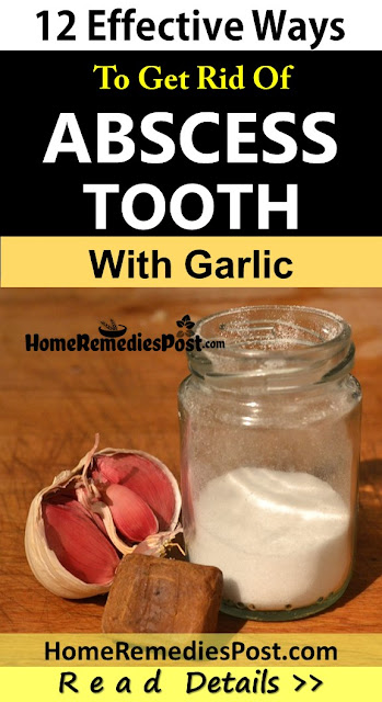 Garlic for Abscess Tooth, Garlic for tooth abscess, is garlic good for abscess tooth, How to Use Garlic for Abscess Tooth, How To Get Rid Of Abscess Tooth, Home Remedies For Abscess, How To Treat Abscess Tooth, How To Cure Abscess Tooth,