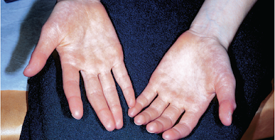 Acrocyanosis ICD-10, Definition, Pictures, Symptoms, Causes, Treatment