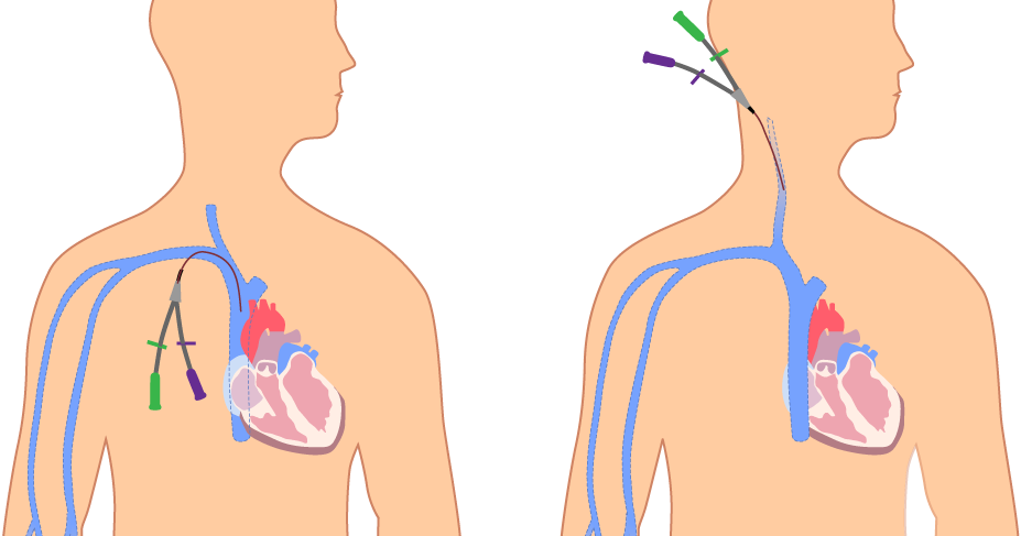 Катетеризация центральных вен Катетеризация центральных вен