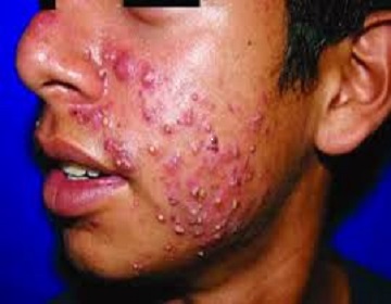 Symptoms of acne