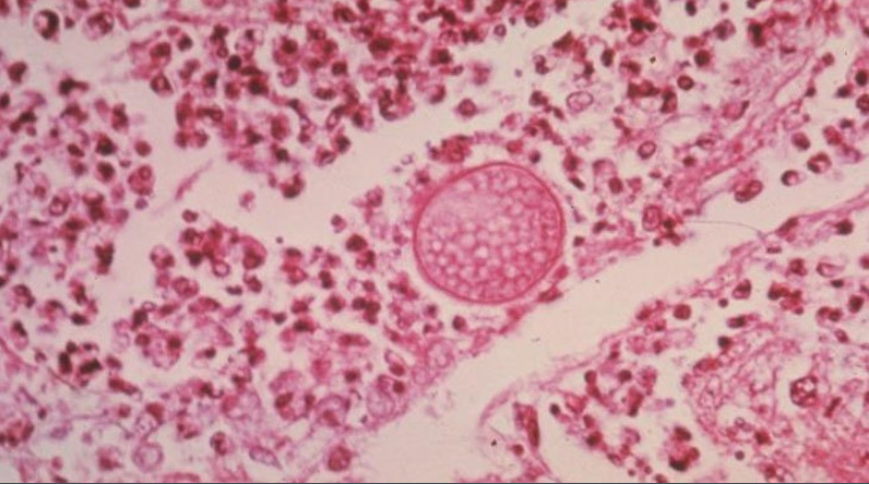 Infecciones causadas por Hongos (fiebre del valle)