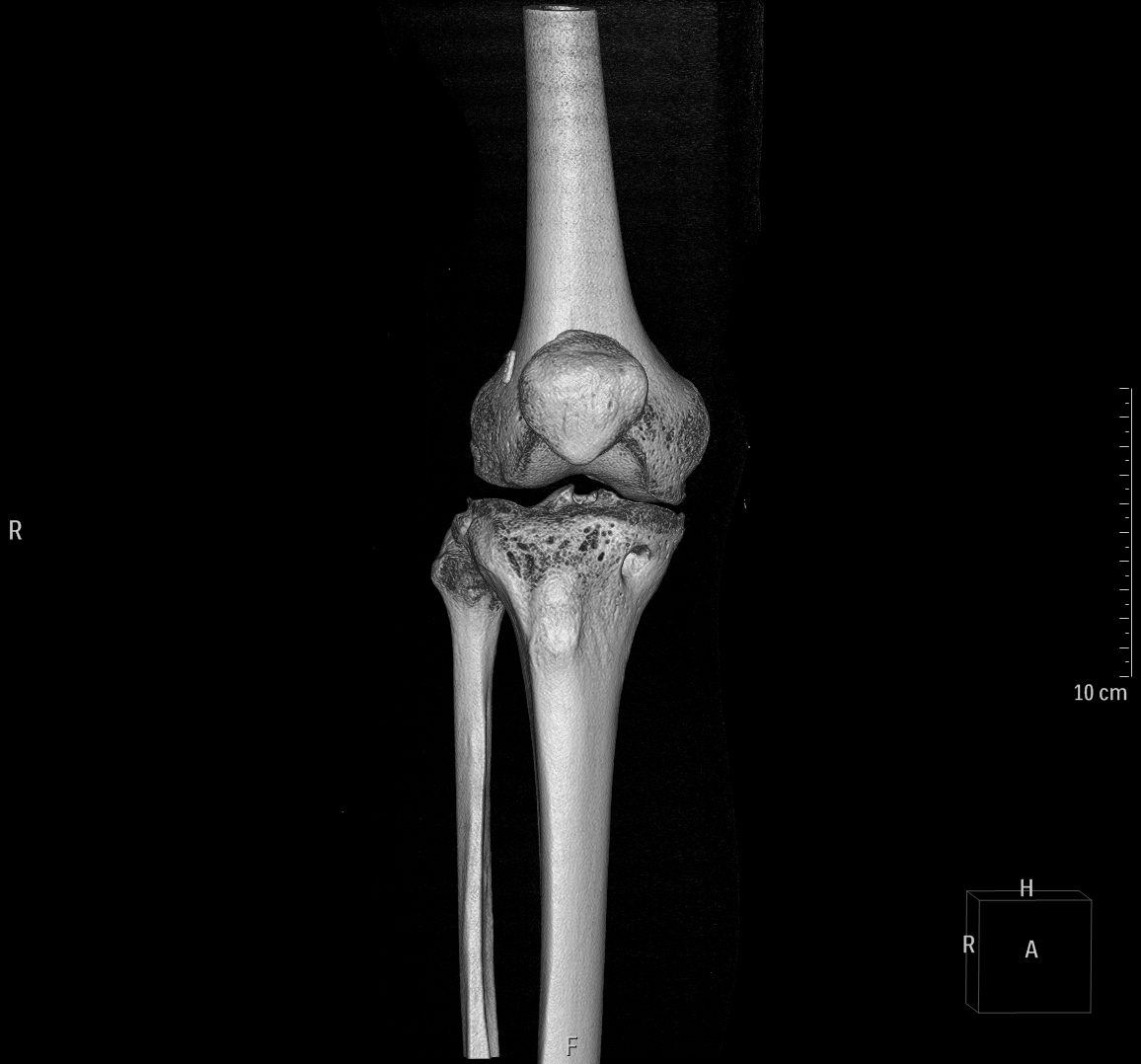 CT Knee Radiology Imaging