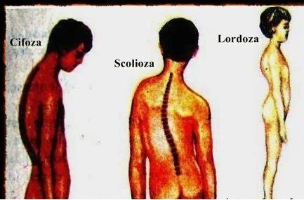 stressende til bundet Supplement Scolioza, cifoza și lordoza - Deviațiile patologice ale coloanei vertebrale  - SfatFarma