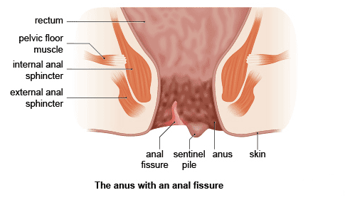 Anal burning and pain
