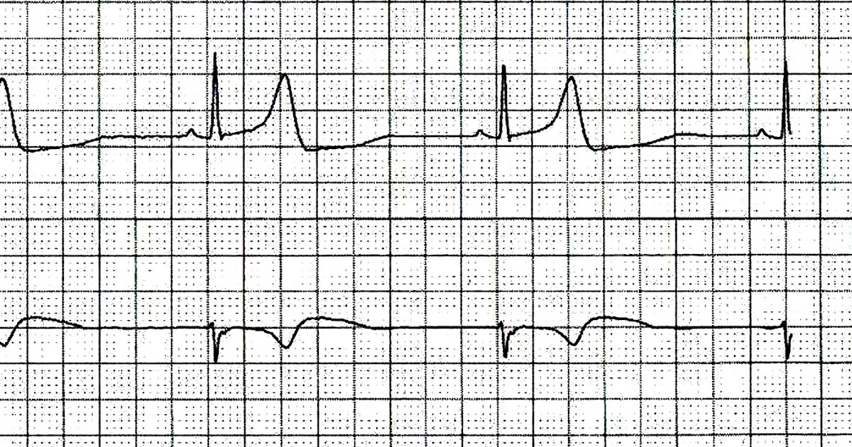 ECG Channel Sinus Bradycardia ecg-channel-sinus-bradycardia