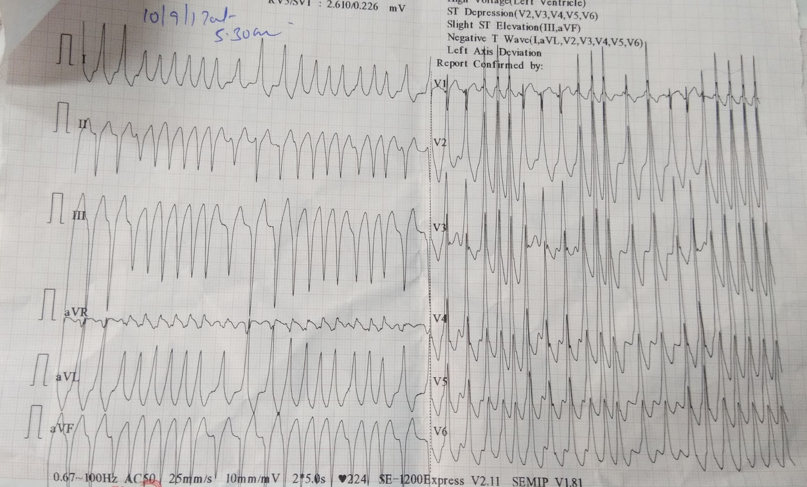 Cardiology window: WPW syndrome with atrial fibrillation