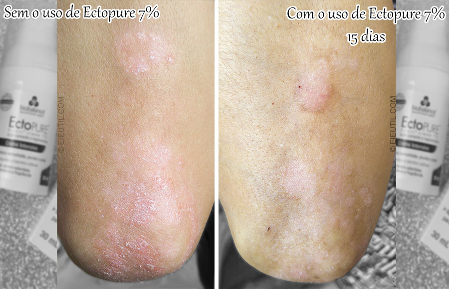 EctoPURE 7%, um aliado na Psoríase - Biobalance