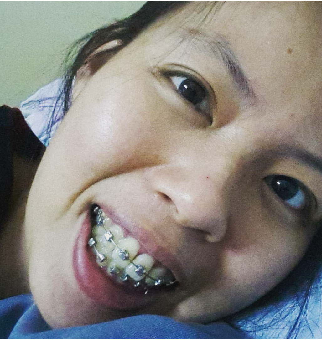 Pengalaman Pakai Braces A.K.A Pendakap Gigi Di Dr Faiz Dental Surgery