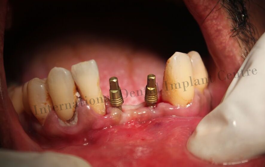 Best laser dental clinic Mugalivakkam Flapless Dental Implant with