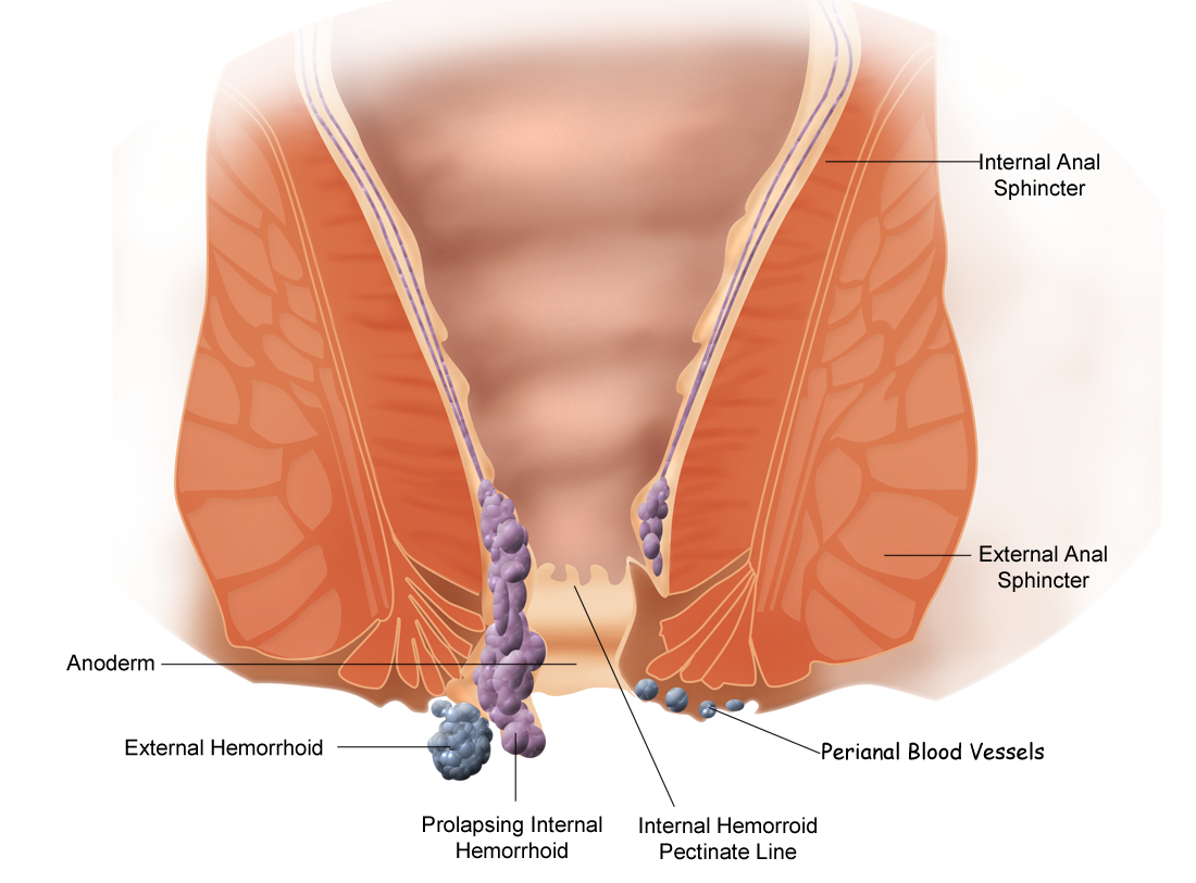 External Hemorrhoid Treatment And Prevention