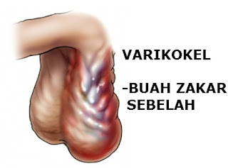 Penyakit Varikokel