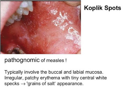Gejala Campak/ Measles/ morbili/ rubeola , cara pengobatan dan komplikasinya