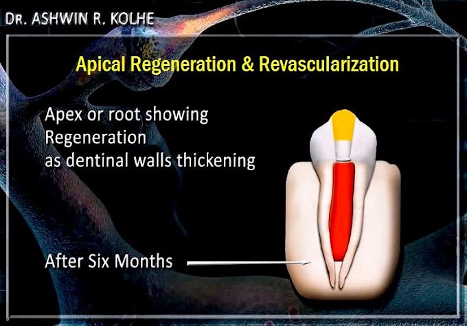 APICAL REGENERATION & REVASCULARIZATION - Dr. Ashwin Kolhe