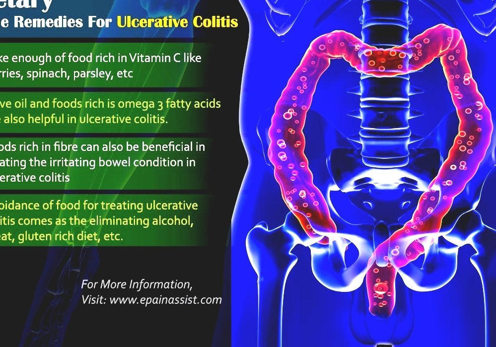 Management Of Ulcerative Colitis - Fish Oil And Ulcerative Colitis