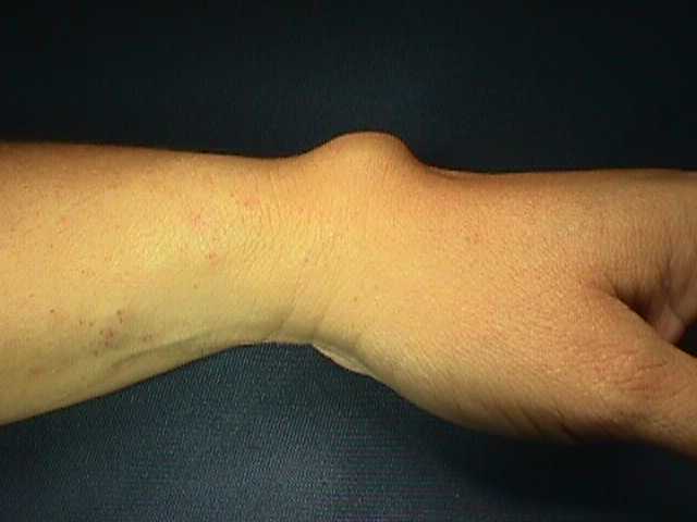 OSSA CARPALIA ©: GANGLION DE LA MUÑECA.