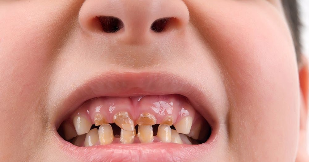 Tips for Preventing Baby Bottle Tooth Decay OdontoBebé