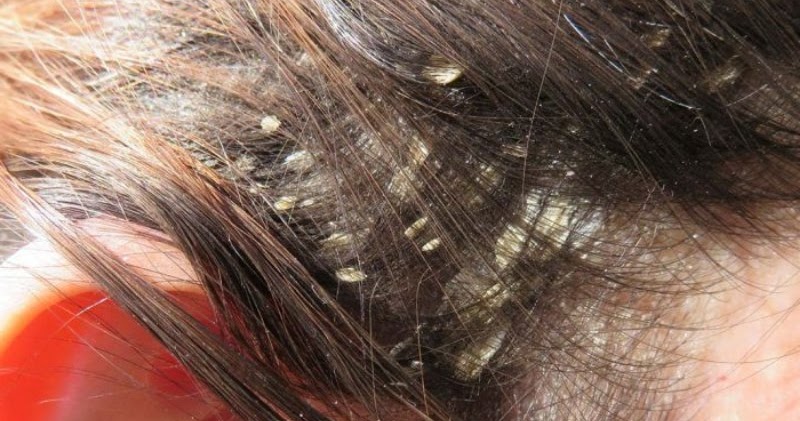 Perawatan rambut rontok