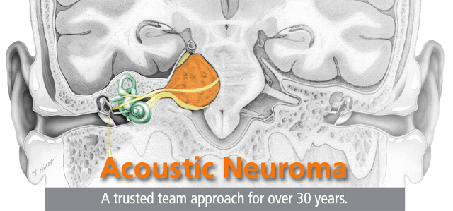 acoustic-neuroma
