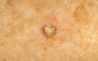 Actinic keratosis