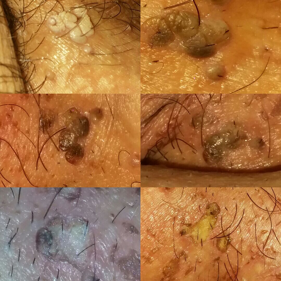 Antes e depois... - HPV